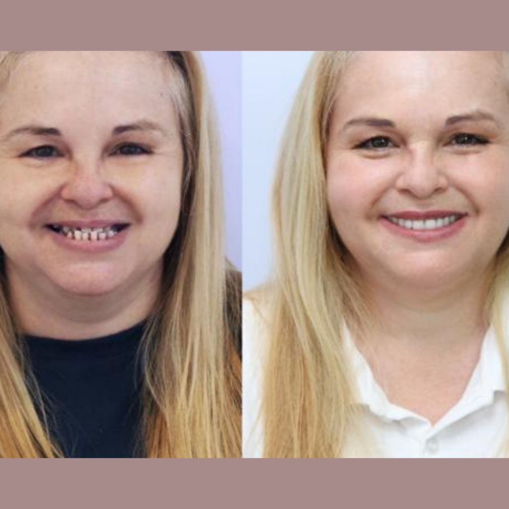 ideal estetica oral implante e prótese